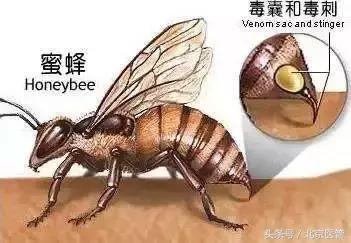 被蜂蜇伤怎么处理好得快,被蜂蜇伤的正确方法