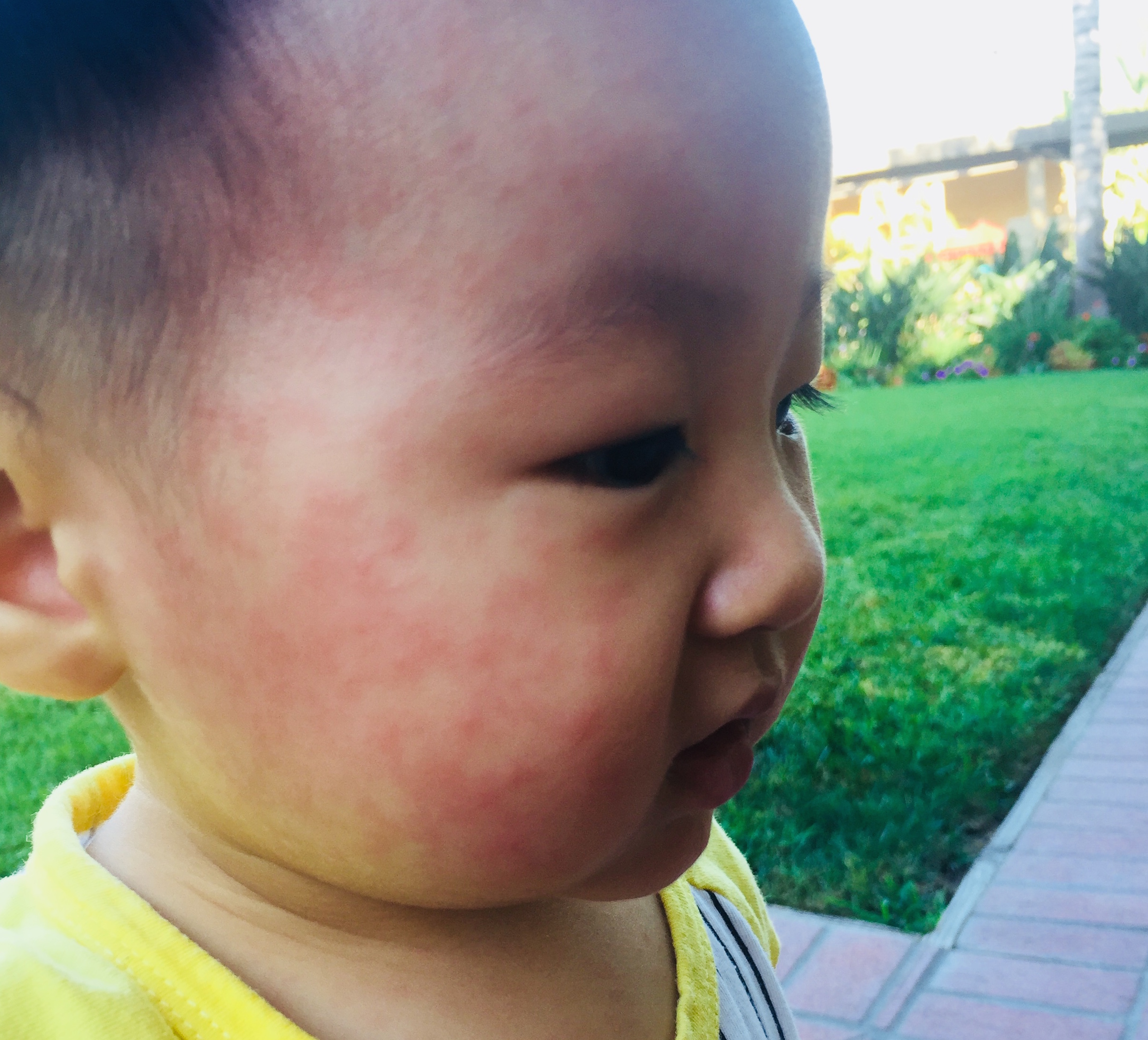 小孩出急疹怎么治疗,宝宝出幼儿急疹期间发烧怎么办