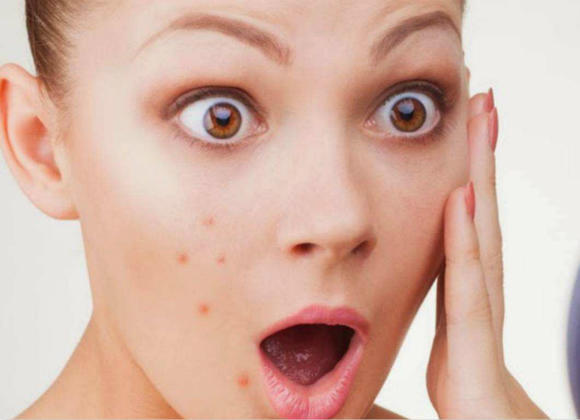 为什么别人的青春期没有痘痘?本期文章不藏私战痘好物起底