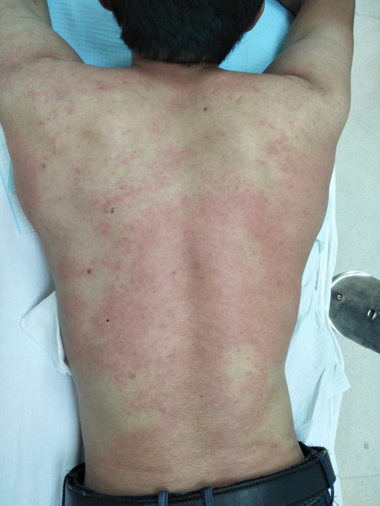 被蜜蜂蛰了的死亡率有多少,人被蜜蜂蛰了人会死吗