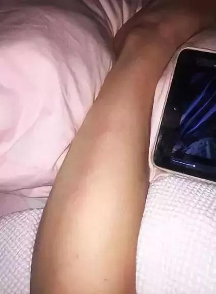 25岁女子脑里有寄生虫,深圳一位20岁女孩大脑长了寄生虫