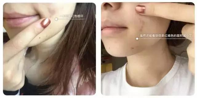 盛夏都快过完了,听说你的大腿还没变白?