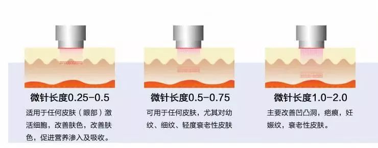 美肤微针,肌肤管理微针