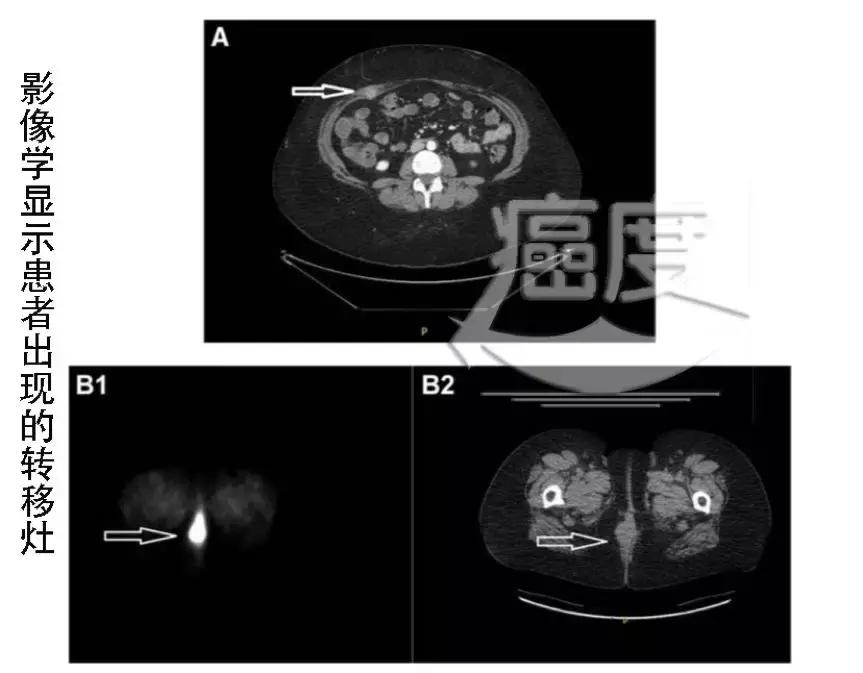 pd-1为什么这么火,pd-1能活多久