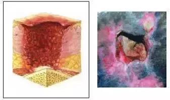 压疮预防指南推荐,压疮的治疗最新进展ppt