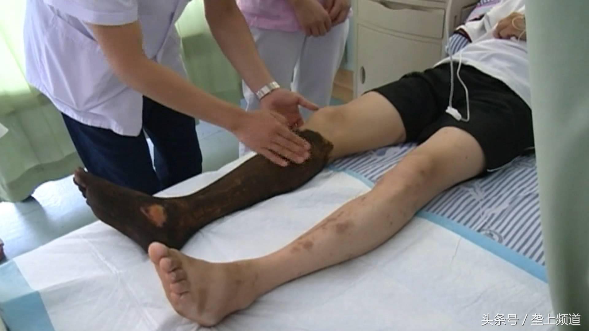 被毒蛇咬到如何自救,被毒蛇咬怎么保命