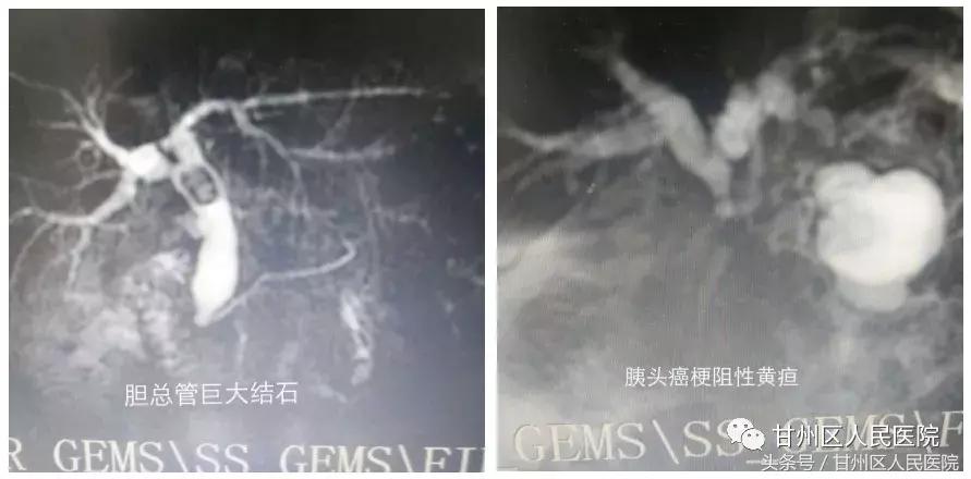 治疗肝内胆管癌新技术,中医治疗胰管结石慢性胰腺炎