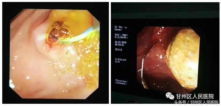治疗肝内胆管癌新技术,中医治疗胰管结石慢性胰腺炎