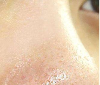 解决毛孔粗大简单有效的方法,毛孔粗大如何拯救学生党