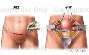 一种“隐形”治疗子宫肌瘤的方法!