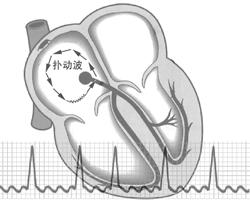 房扑是严重的心脏病吗,房扑与脑梗的联系