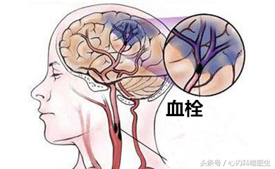 有什么除心脑血管血栓的药物,心脑血栓的防治方法