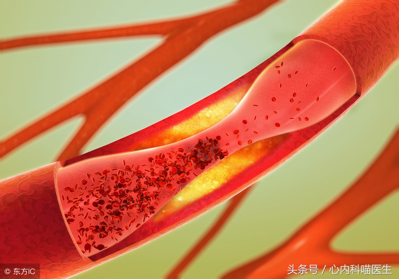 有什么除心脑血管血栓的药物,心脑血栓的防治方法