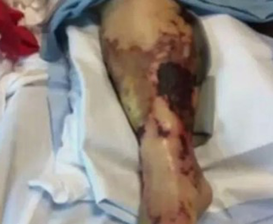 女性吃了生蚝的危害,女子吃生蚝20天死亡