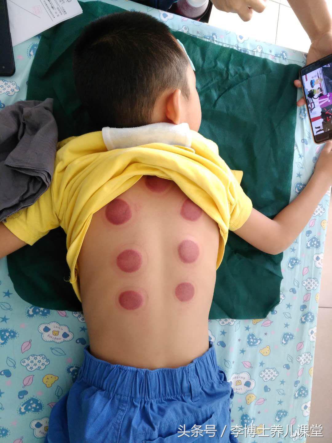 疱疹性咽峡炎和手足口病注意事项,疱疹性咽峡炎手足口哪个更严重