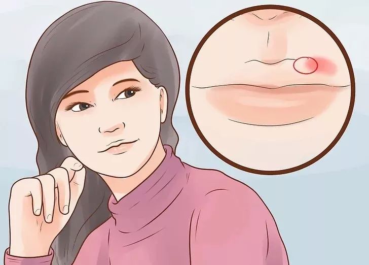 嘴巴上起泡了是怎么回事,嘴巴上起泡了怎么快速消除不用药