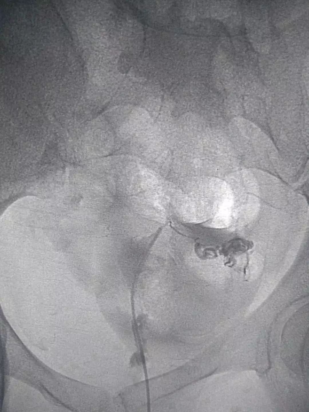 输卵管堵塞介入治疗法是怎么回事,输卵管堵塞介入治疗