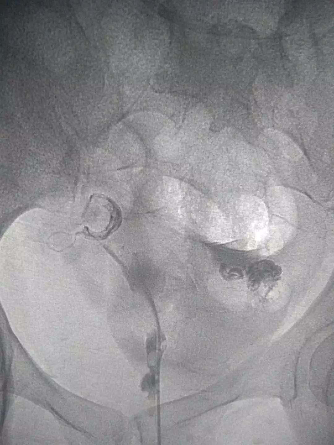 输卵管堵塞介入治疗法是怎么回事,输卵管堵塞介入治疗