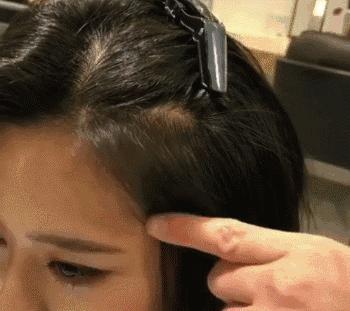 杨幂全脸脂肪填充图片,杨幂胎毛发际线教程