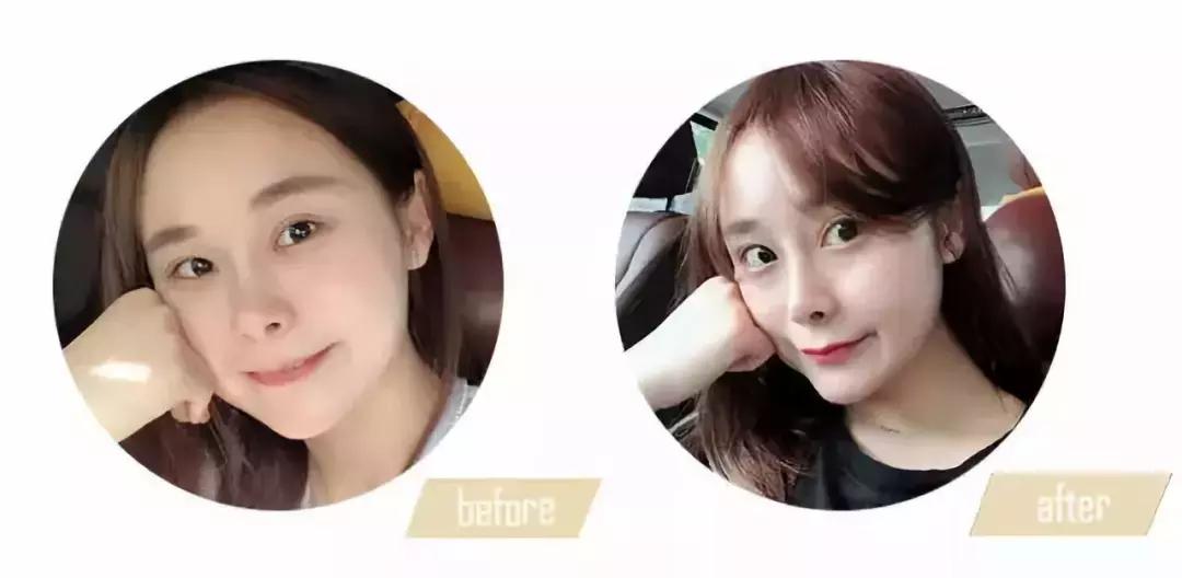 杨幂全脸脂肪填充图片,杨幂胎毛发际线教程