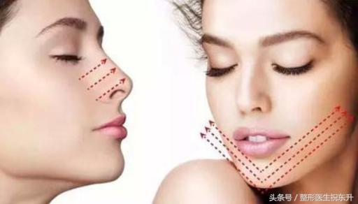 做大v线雕有副作用吗,脸部做了大v线雕会肿几天