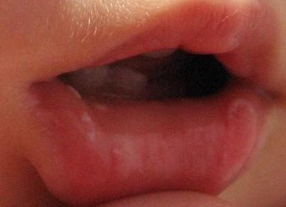 宝宝出现鹅口疮怎么办,鹅口疮出现红色创面是更厉害了吗