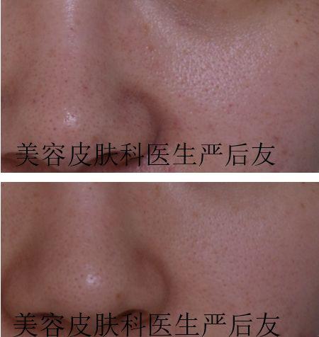 治疗毛孔粗大,激光治疗毛孔粗大多少钱