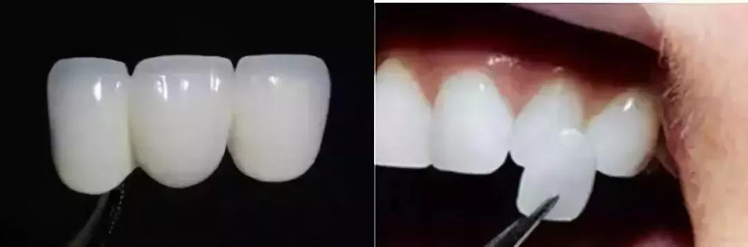 word天!牙齿变白后,人都美了好几度