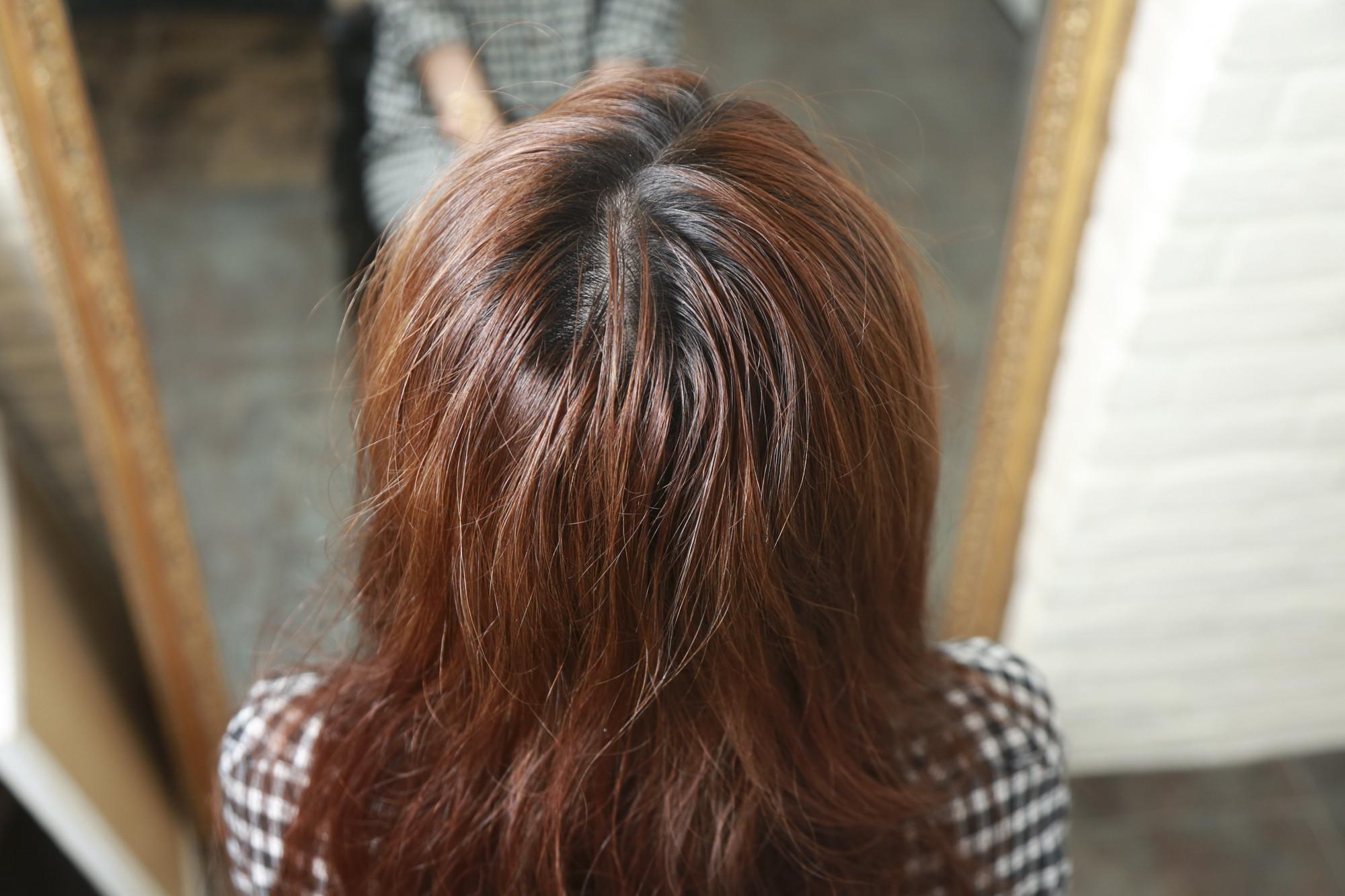 脱发挠头皮,挠头皮脱发怎么办