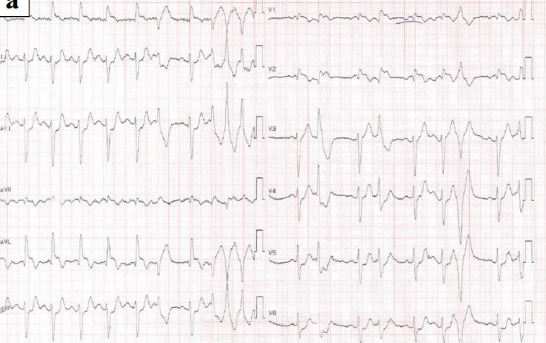 食管癌用纳武利尤单抗怎么办,纳武利尤单抗发生过敏怎么办