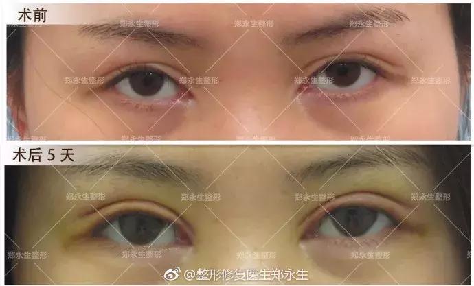 双眼皮刚割完不对称后来好了,全切双眼皮拆线后不对称