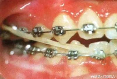 整牙全过程解说,整牙亲身经历15天