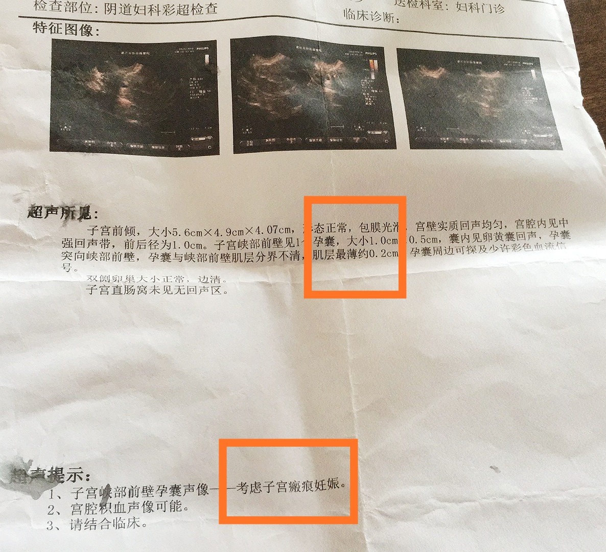 头胎剖宫产二胎疤痕妊娠几率,一胎剖腹产二胎瘢痕处妊娠的几率