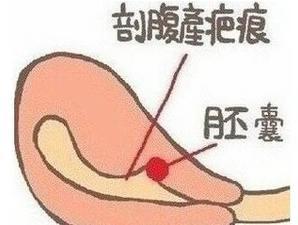 头胎剖宫产二胎疤痕妊娠几率,一胎剖腹产二胎瘢痕处妊娠的几率