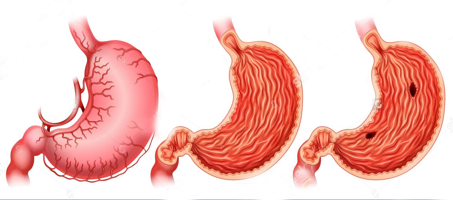 不同胃药的正确服用方法,凤凰草胃药正确服用方法
