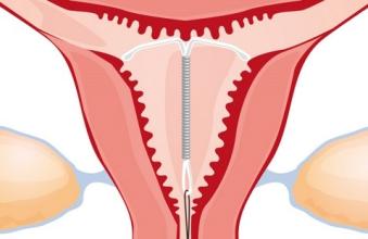 关于产后要不要上节育环，这些方面你要知道