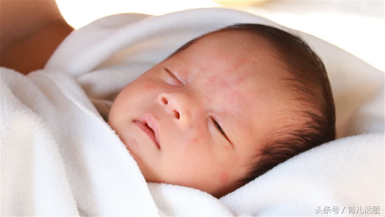 如何避免胎宝宝长胎记,新生儿你不知道的八件事
