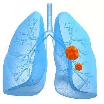 基因检测与靶向治疗肺癌,中科院用计算机技术攻克肿瘤耐药