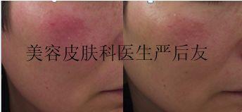 敏感性皮肤用什么化妆品好,敏感性皮肤的特征是什么