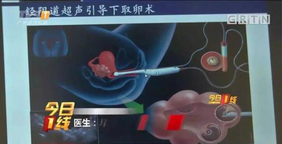 地下代孕黑链调查：14岁少女被骗卖卵，85万一条龙包成功！