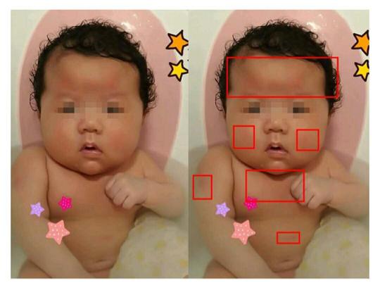 日男星3个月女儿疑受虐，摔3次头肿全身红块，仍未脱离危险