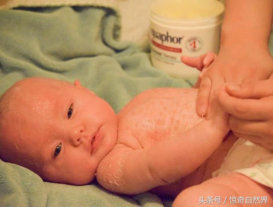 婴儿鱼鳞病出生就有吗,婴儿鱼鳞病多久会死