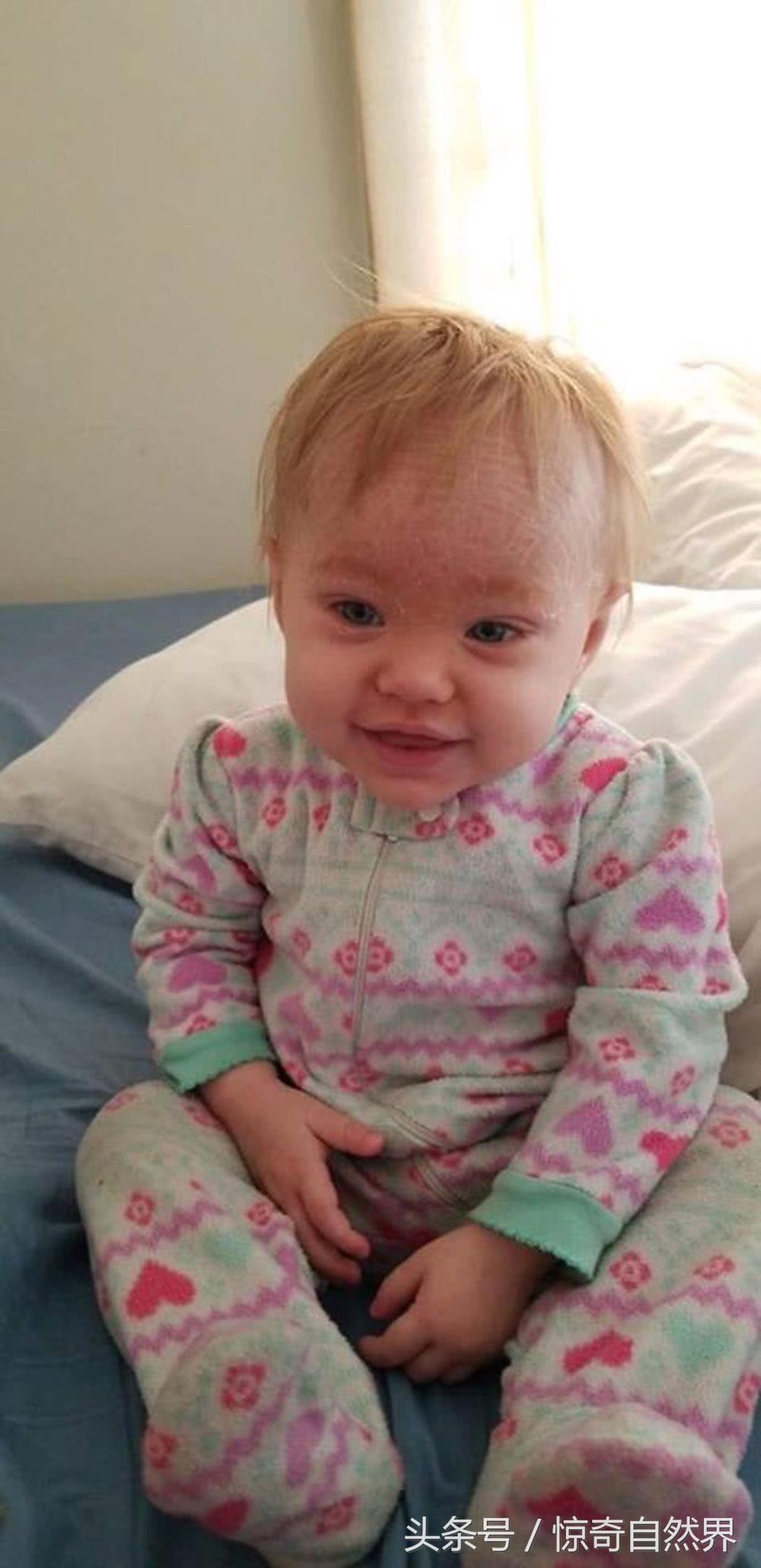 婴儿鱼鳞病出生就有吗,婴儿鱼鳞病多久会死