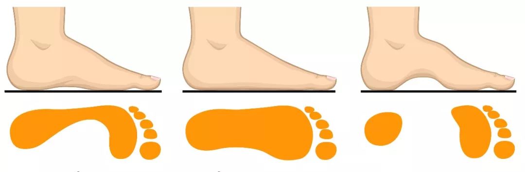 儿童扁平足矫正方法,儿童扁平足不治疗会怎么样