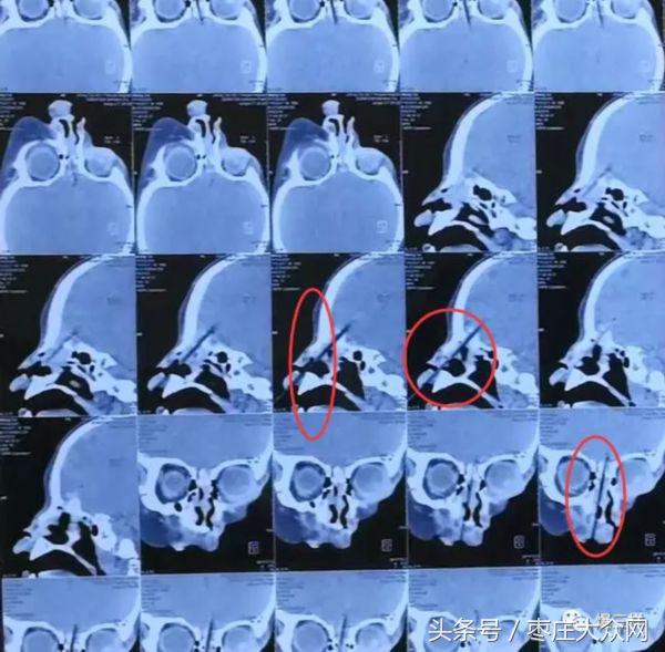 1岁男童吃烤肠摔倒3竹签刺入颅脑,一岁半男孩吃烤肠竹签刺入大脑