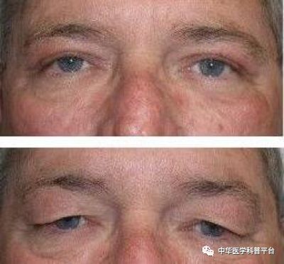 美容整形怎么将脸变小,整形脸为什么会变僵