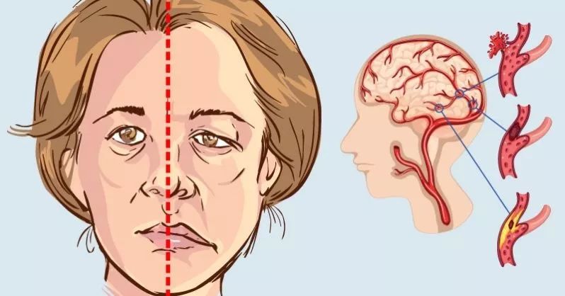 高血压怎么样才能发生猝死,高血压隐形杀手