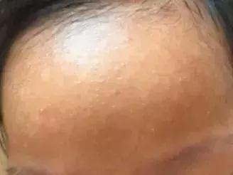 宝宝身上一大片的包是怎么回事,宝宝身上好多片包