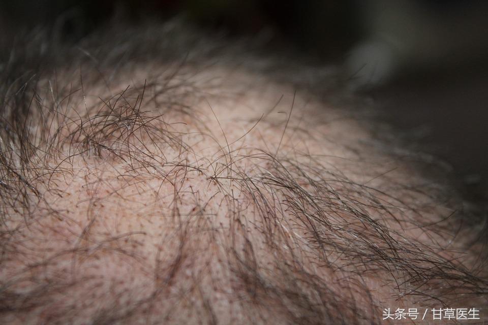 头发生长是吸收营养还是血,头发长吸血