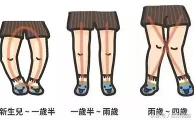 婴儿缺钙腿会长不直吗,婴儿腿不直怎么治最有效